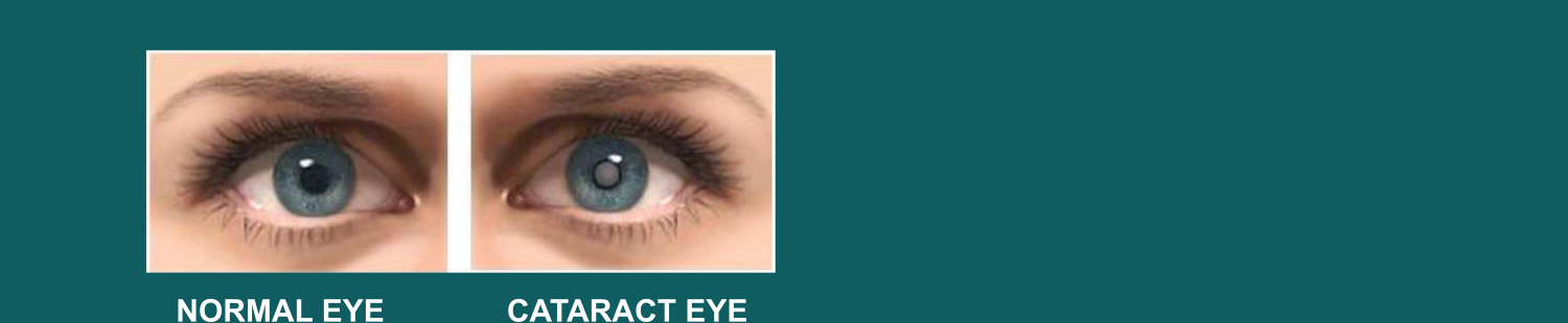 cataract_eye_treatment_surgery_doctor_near_me
